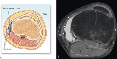 Pes Anserinitis | Dr HC Chang