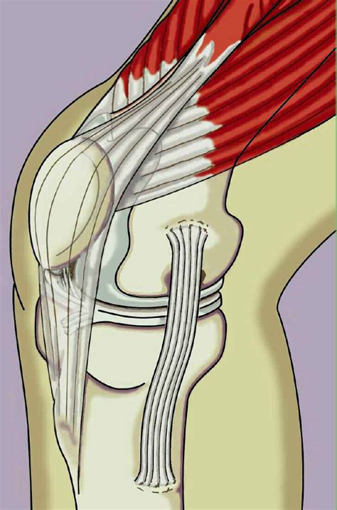 Patellofemoral Pain Syndrome - The Institute for Athletic Medicine