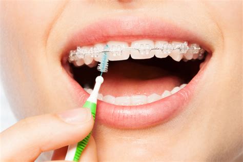 Tips for Flossing with Braces: Know how these tips may help you.