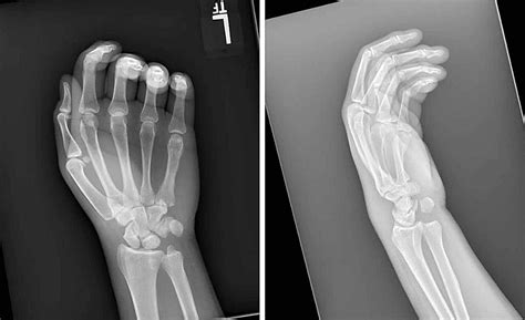 Distal Radioulnar Dislocation