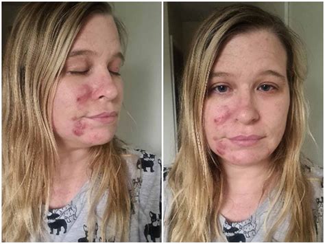 Woman hails £85 skincare kit as ‘miracle cure’ for her cystic acne ...