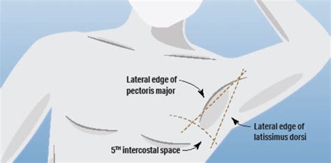 How Do Small and Large Catheters Compare in Hemodynamically Stable ...