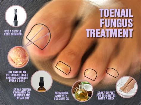 Pin on Toenail fungus remedies