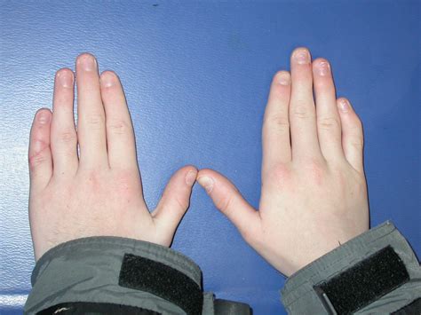 Congenital Hand and Arm Differences: July 2012