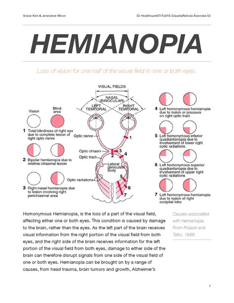 Partial Hemianopia Nih Stroke Scale