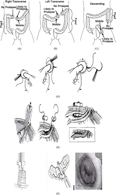 Intestinal Stoma Prolapse | Semantic Scholar