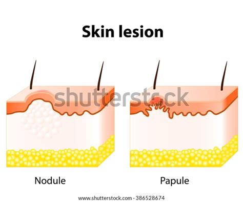 Papule Nodule Skin Lesion Stock Illustration 386528674