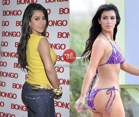 Kim Kardashian Buttocks Before And After Butt Implants