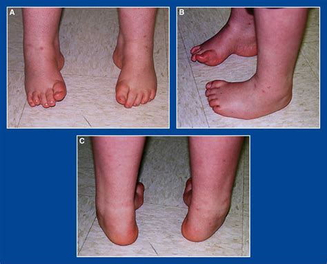 CAVUS - FOOT AND ANKLE DEFORMITIES - Principles and Management of Pediatric Foot and Ankle ...