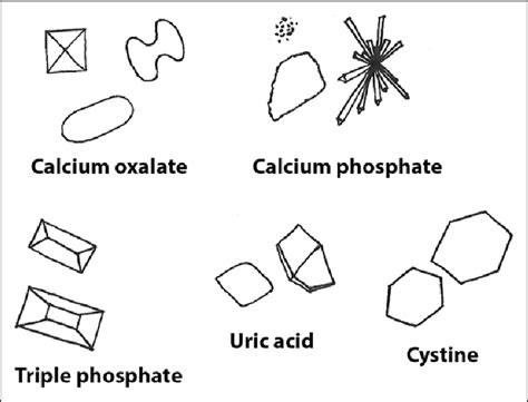 If crystals are visualized on microscopic examination of the urine, the... | Download Scientific ...