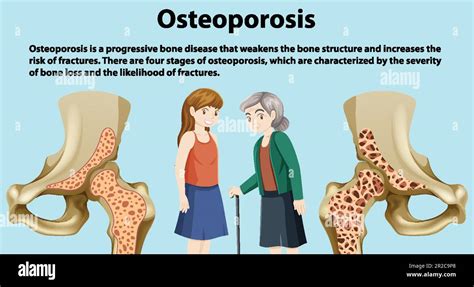 Bone Density and Osteoporosis Vector illustration Stock Vector Image & Art - Alamy