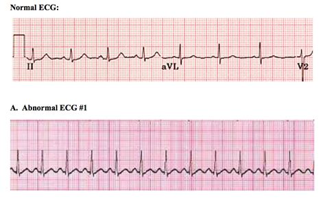 Solved For each of the following ECGs: (1) write what you | Chegg.com