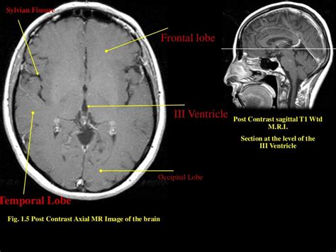 MRI SECTIONAL ANATOMY OF BRAIN