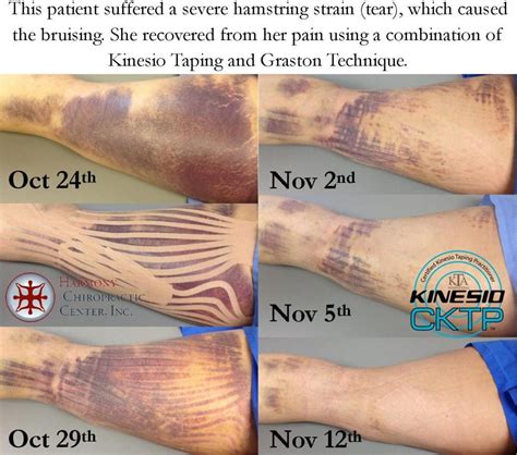 Kinesio Taping in Sylvania & Toledo • Harmony Chiropractic