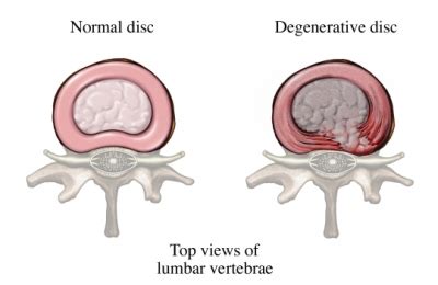 Degenerative Disc Disease | UVA Health