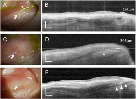 Optical coherence tomography dacryography (OCTD) images of the lacrimal ...