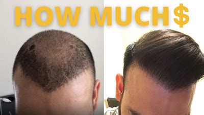 News: How Much Does A Hair Transplant Cost?