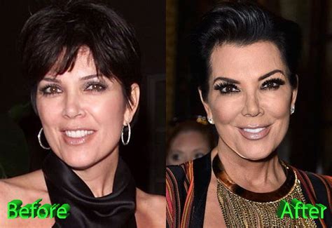 Kris Jenner Plastic Surgery: A Really Beautiful Granny