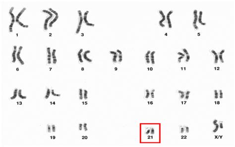 Novel insight into chromosome 21 and its effect on Down syndrome | UCL News - UCL – University ...