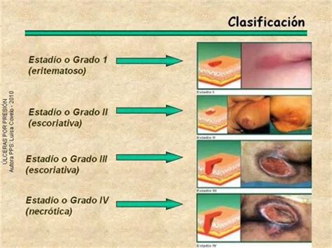 ulceras por presion primera parte - YouTube