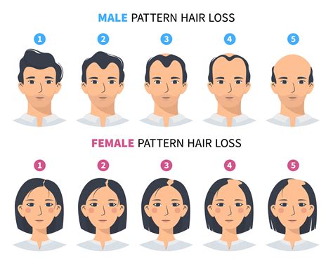 Hair loss stages, androgenetic alopecia male and female pattern. Steps of baldness vector ...