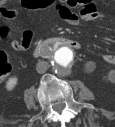 Clinical Case: Hematemesis and abdominal pain - MDCT.net