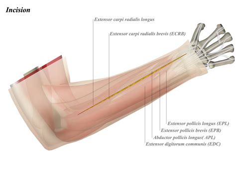 (x) Forearm Dorsal Surgical Approach - Anatomy - Medbullets Step 2/3