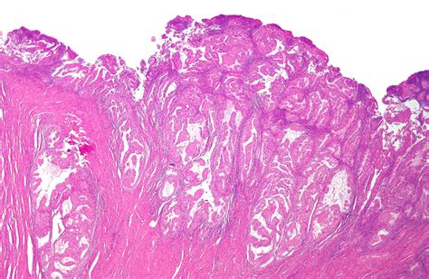 Endometrial Carcinoma - Oncology - Medbullets Step 1