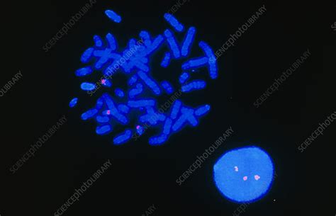 FISH micrograph of chromosomes in Down's Syndrome - Stock Image - M352/0011 - Science Photo Library