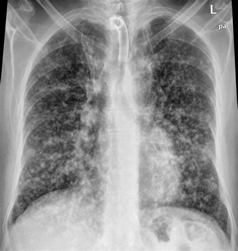 for the love of med school: Imaging Interstitial Lung Disease