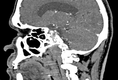 Necrotizing otitis externa | Image | Radiopaedia.org