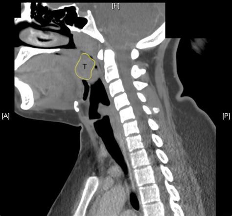 Tonsillar Abscess Treatment