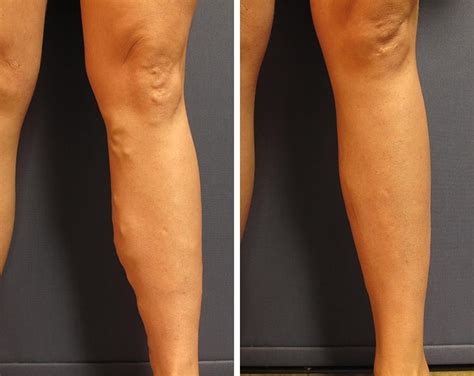 Varicose Vein Treatment Before and After | Vein Photos