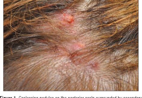 Figure 2 from Angiolymphoid hyperplasia with eosinophilia. - Semantic ...