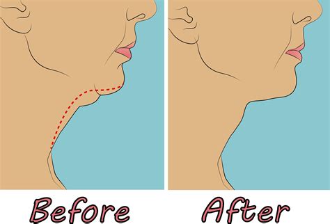 Procedure Double Chin Exercises