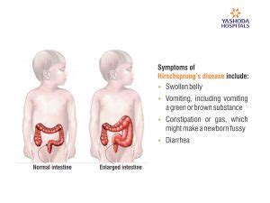 Hirchsprung’s Disease Symptoms, Risk Factors and Treatment