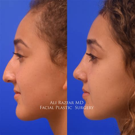 Hispanic Rhinoplasty Orange County, Hispanic Nose Job Newport Beach