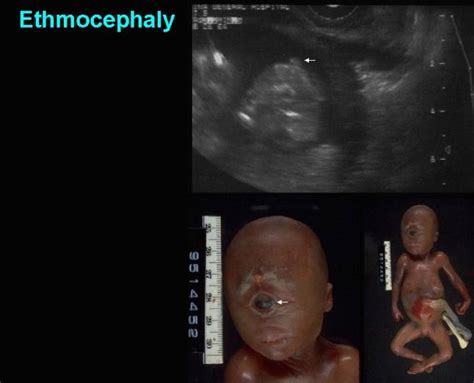 Alobar Holoprosencephaly