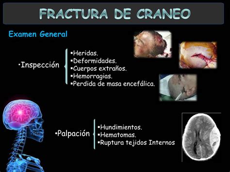 PPT - Fractura de Cráneo PowerPoint Presentation, free download - ID:231055