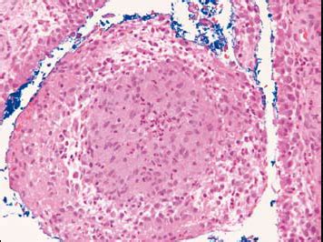 Granulomatous Disease, Chronic