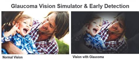 Glaucoma Vision Simulator