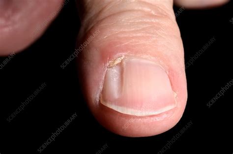 Grooved nail with mucous cyst - Stock Image - C042/6366 - Science Photo ...