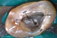 Management of a Maxillary Second Molar - Dentistry Today