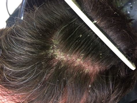 Flaky scalp? This treatment is a revelation | Figaro London