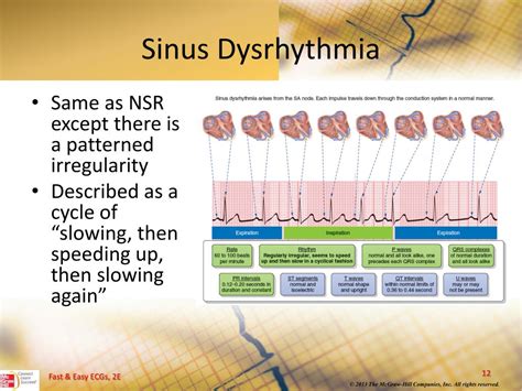 PPT - Sinus Dysrhythmias PowerPoint Presentation, free download - ID:3345190