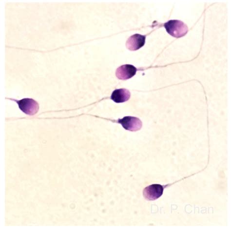 Sperm Morphology | Loma Linda University Center for Fertility & IVF