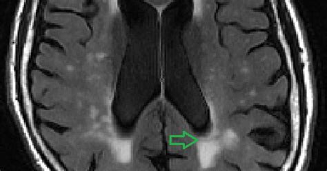 Abnormalities in white matter, known as lesions, are most often seen as bright areas or spots on ...