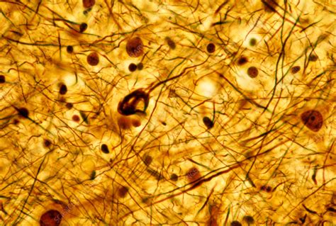 Neurofibrillary tangles in pyramidal neuron, light micrograph - Stock ...