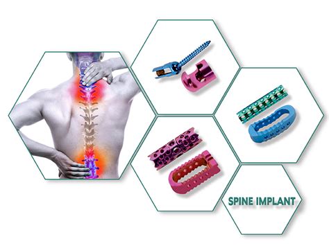 Genius Ortho - Leading Orthopaedic Implants Manufacturers | Orthopaedic ...