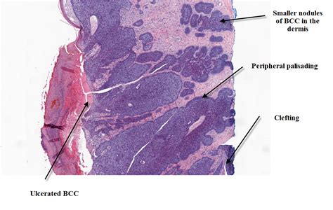 Dermpath Made Simple - Neoplastic: Basal Cell Carcinoma